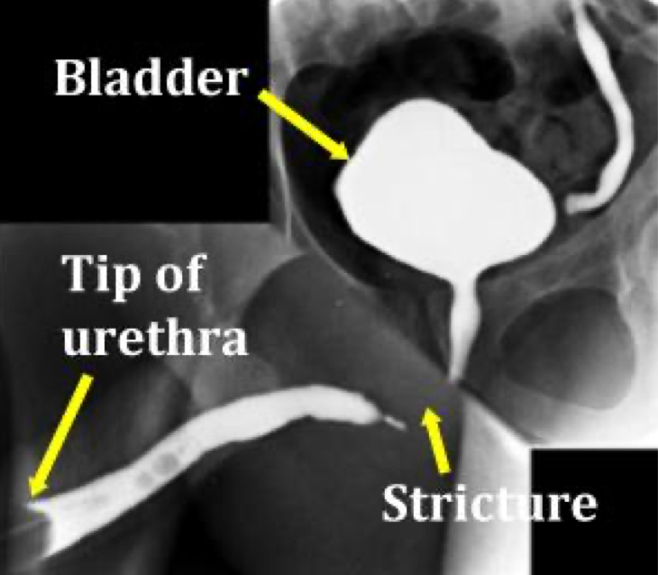 Retrograde urethrogram showing bulbar urethral stricture with bladder, stricture and tip of urethra labelled